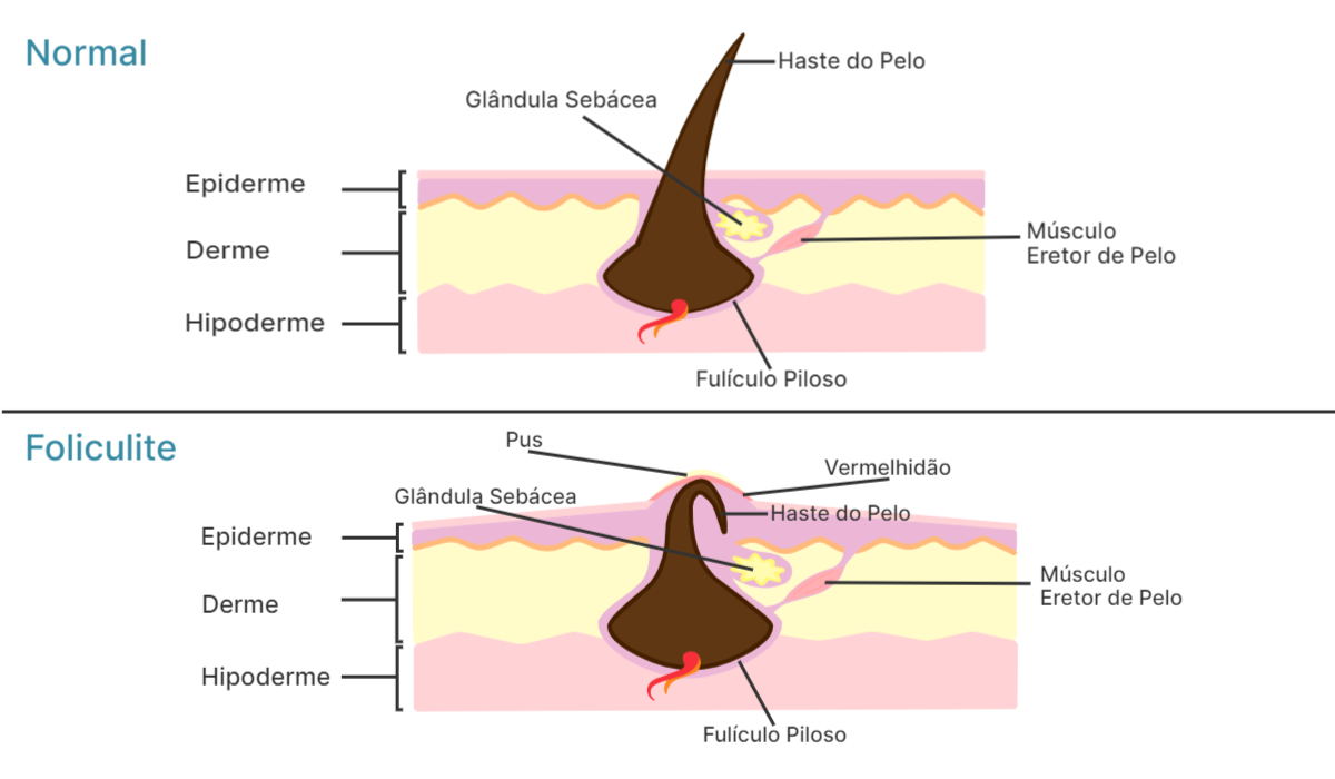 Pelos no corpo Pelos no corpo